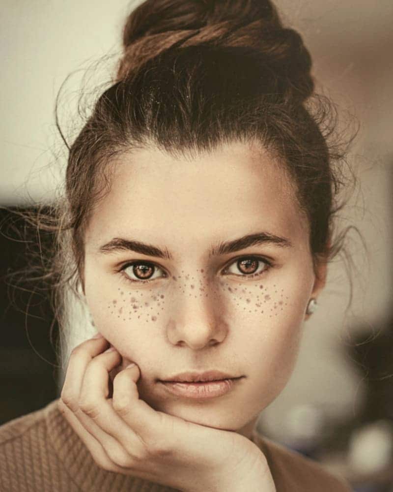 Botulinum · Upper Face · 3