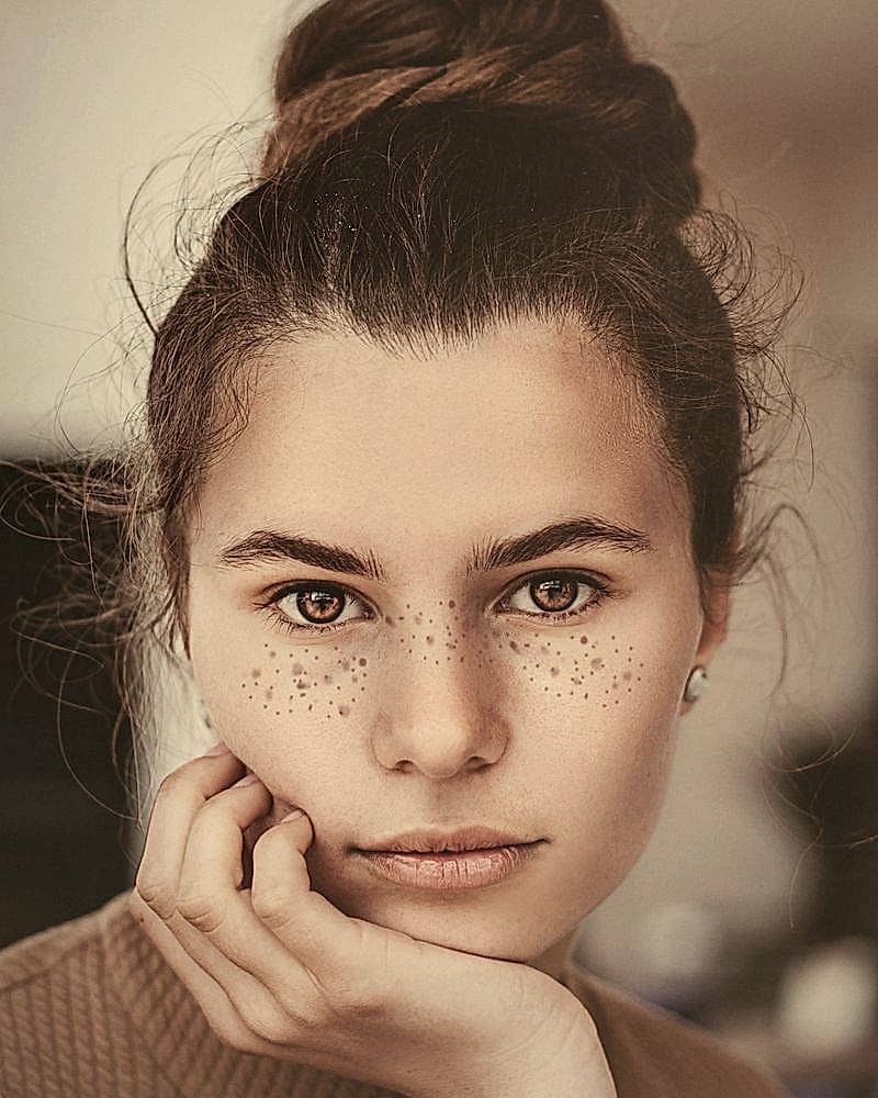 Before · Forehead and glabella at rest · same light, same lens, no retouching.