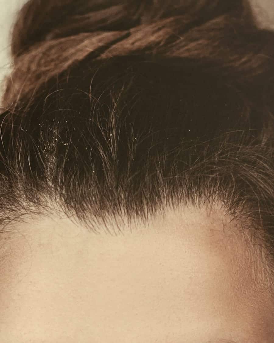 Botulinum · Upper Face