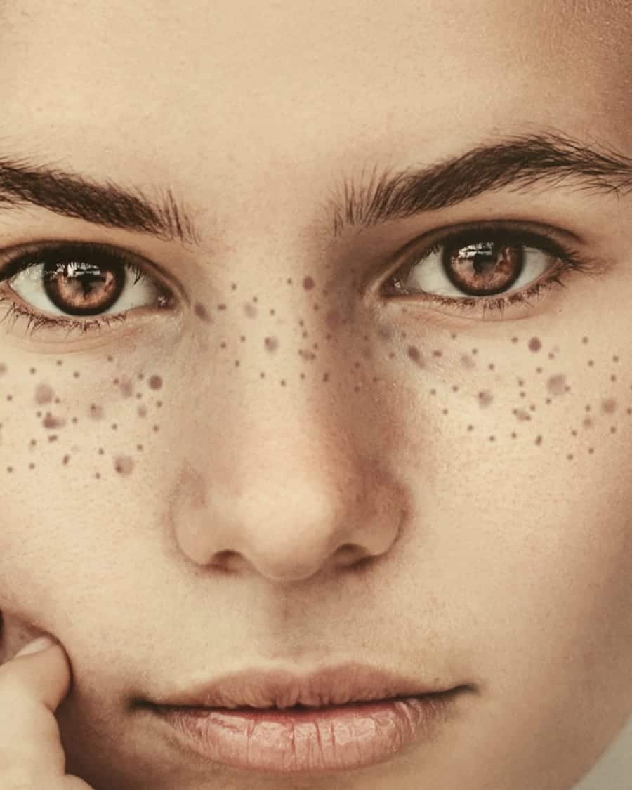 Dermal Filler · Cheek and Chin