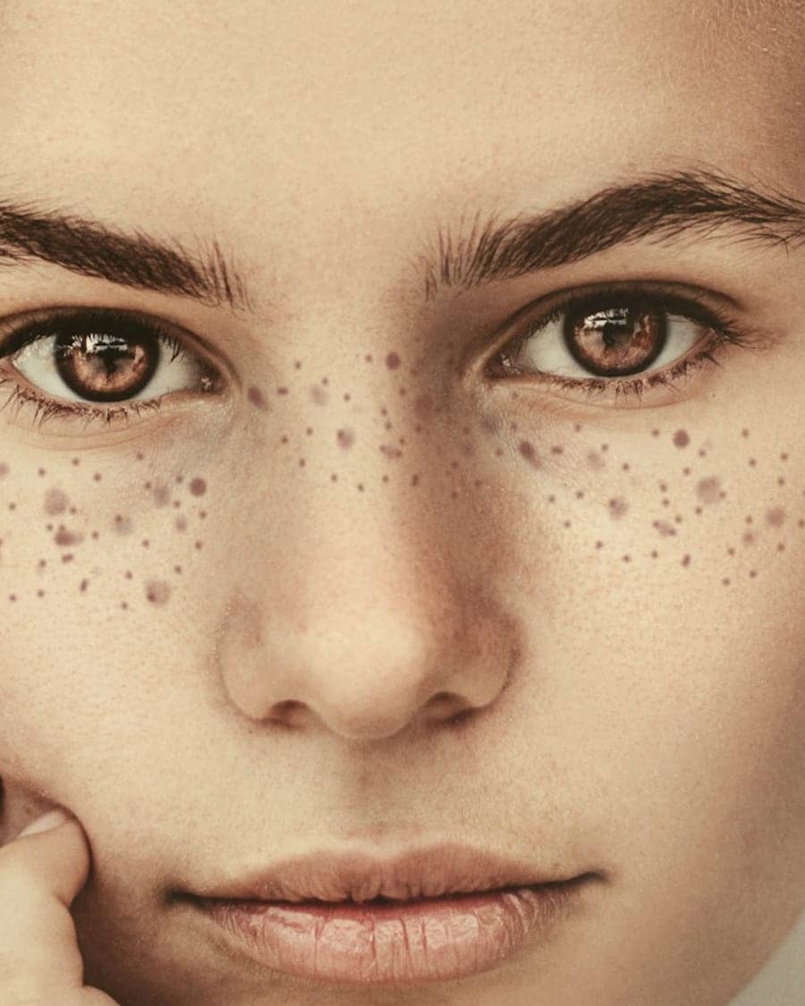 Dermal Filler · Cheek and Chin